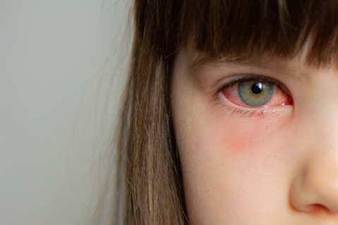Conjunctivitis