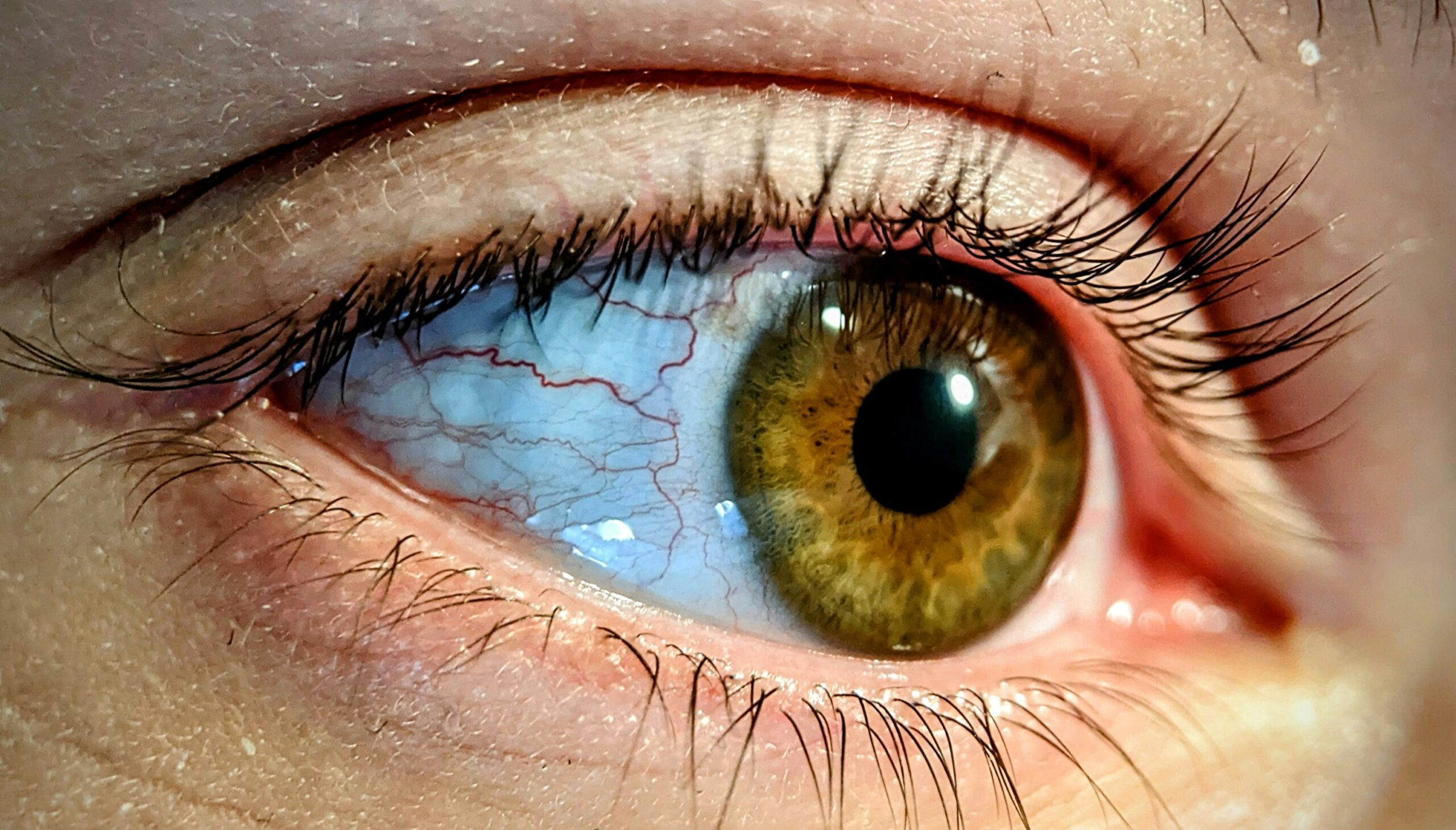 Glaucoma
